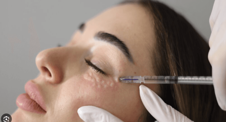 Oog Mesotherapie behandeling bij Noor Clinics
